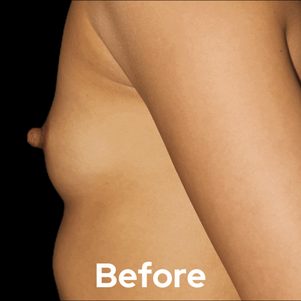 Breast Augmentation - Before and After 06