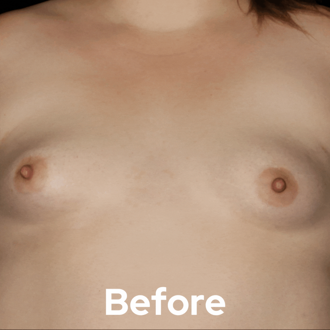 Breast Augmentation - Before and After 07