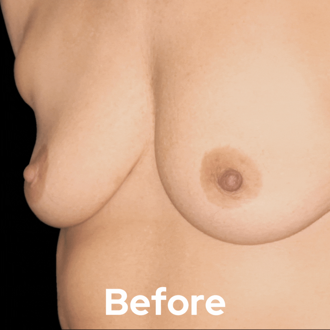 Breast Augmentation - Before and After 09