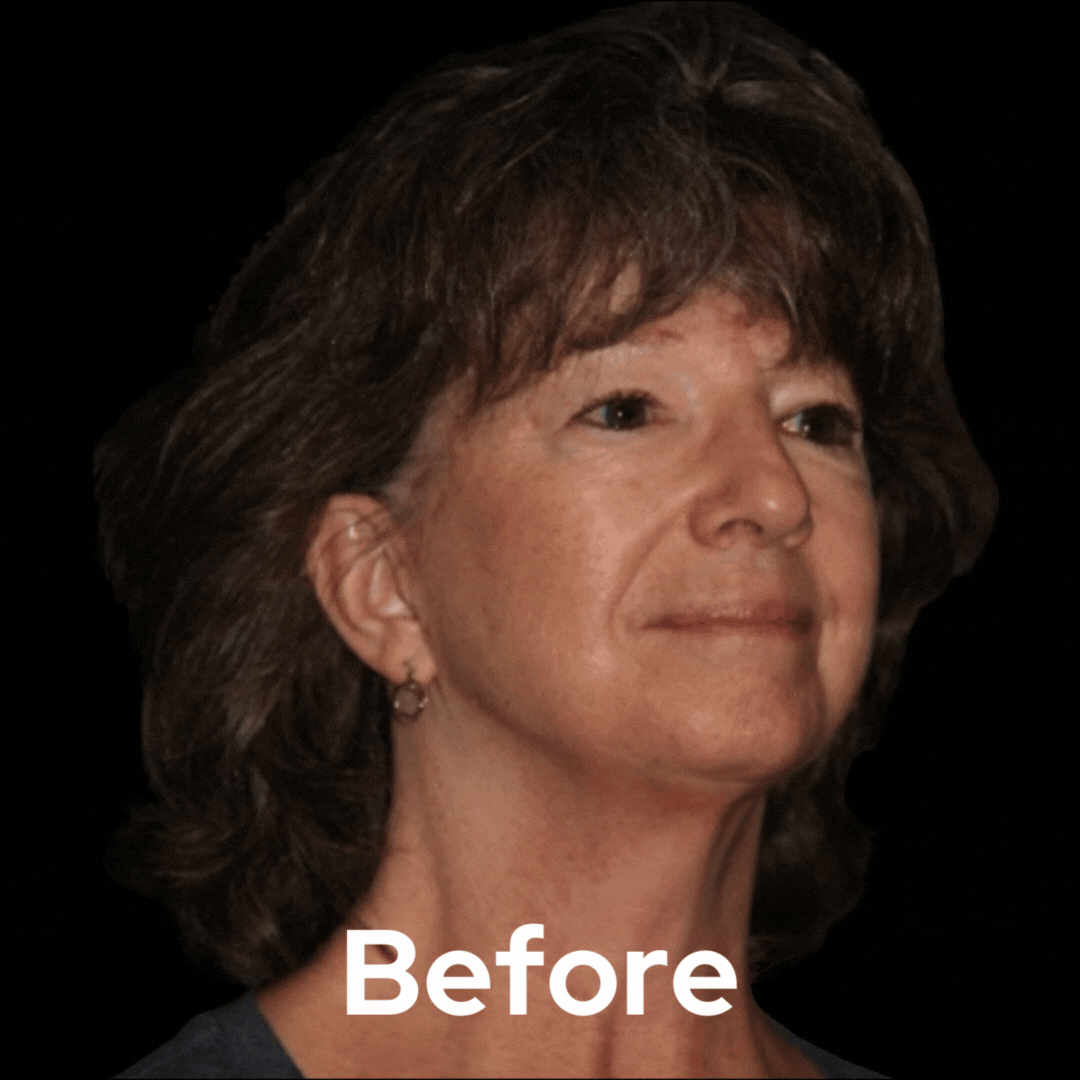 Face and Neck - Before and After 01