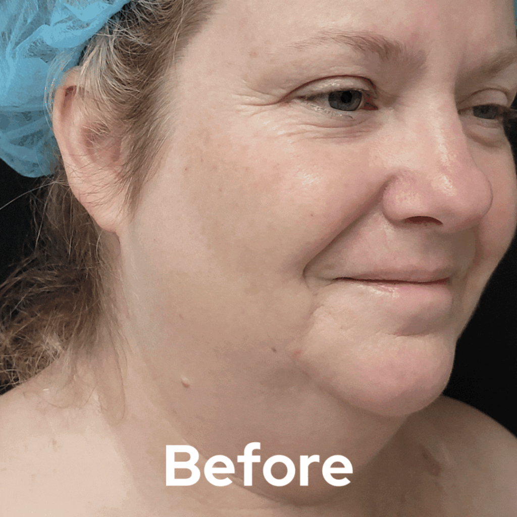 Face and Neck - Before and After 04