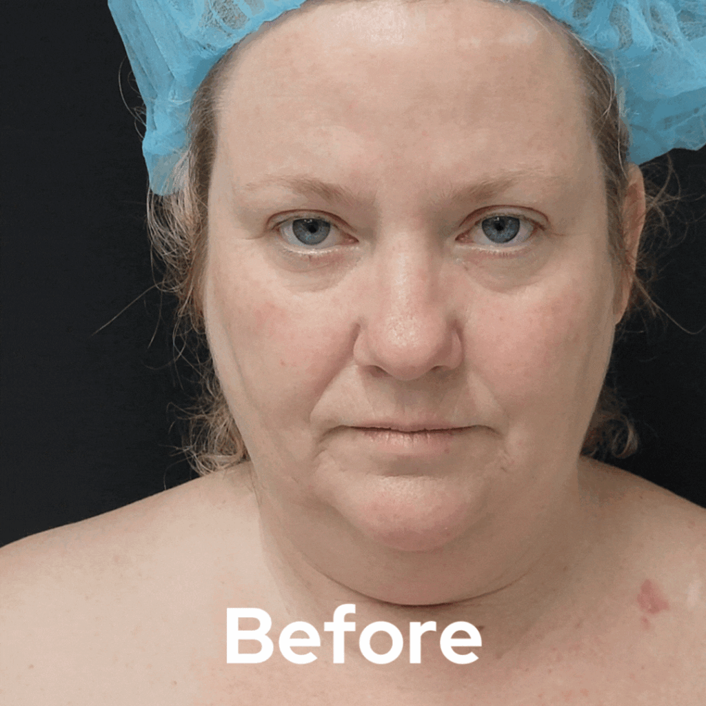 Face and Neck - Before and After 05