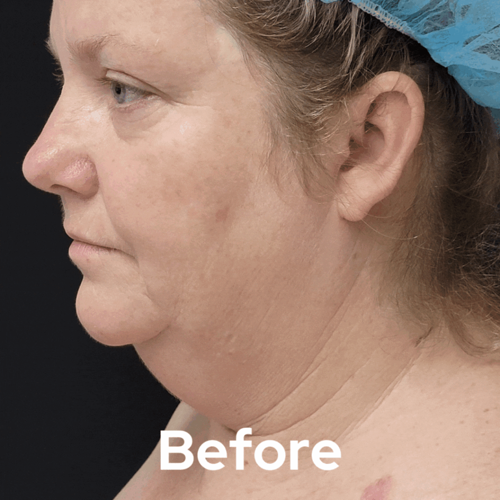 Face and Neck - Before and After 06