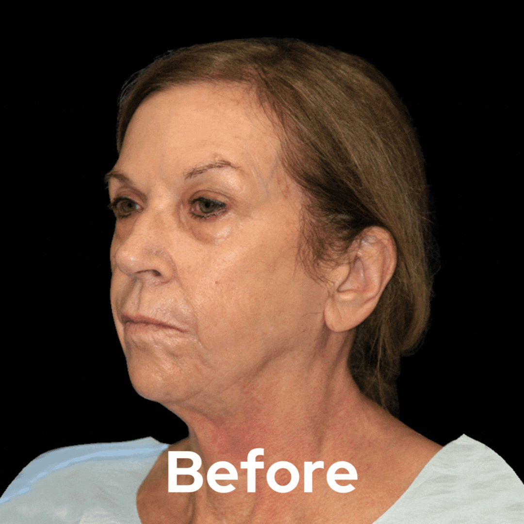 Face and Neck - Before and After 07