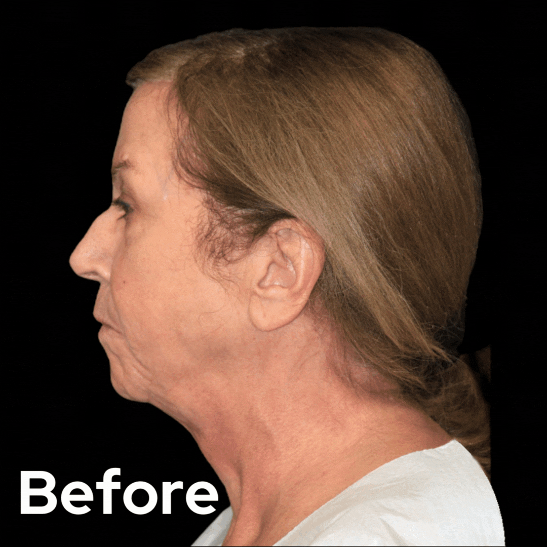 Face and Neck - Before and After 09