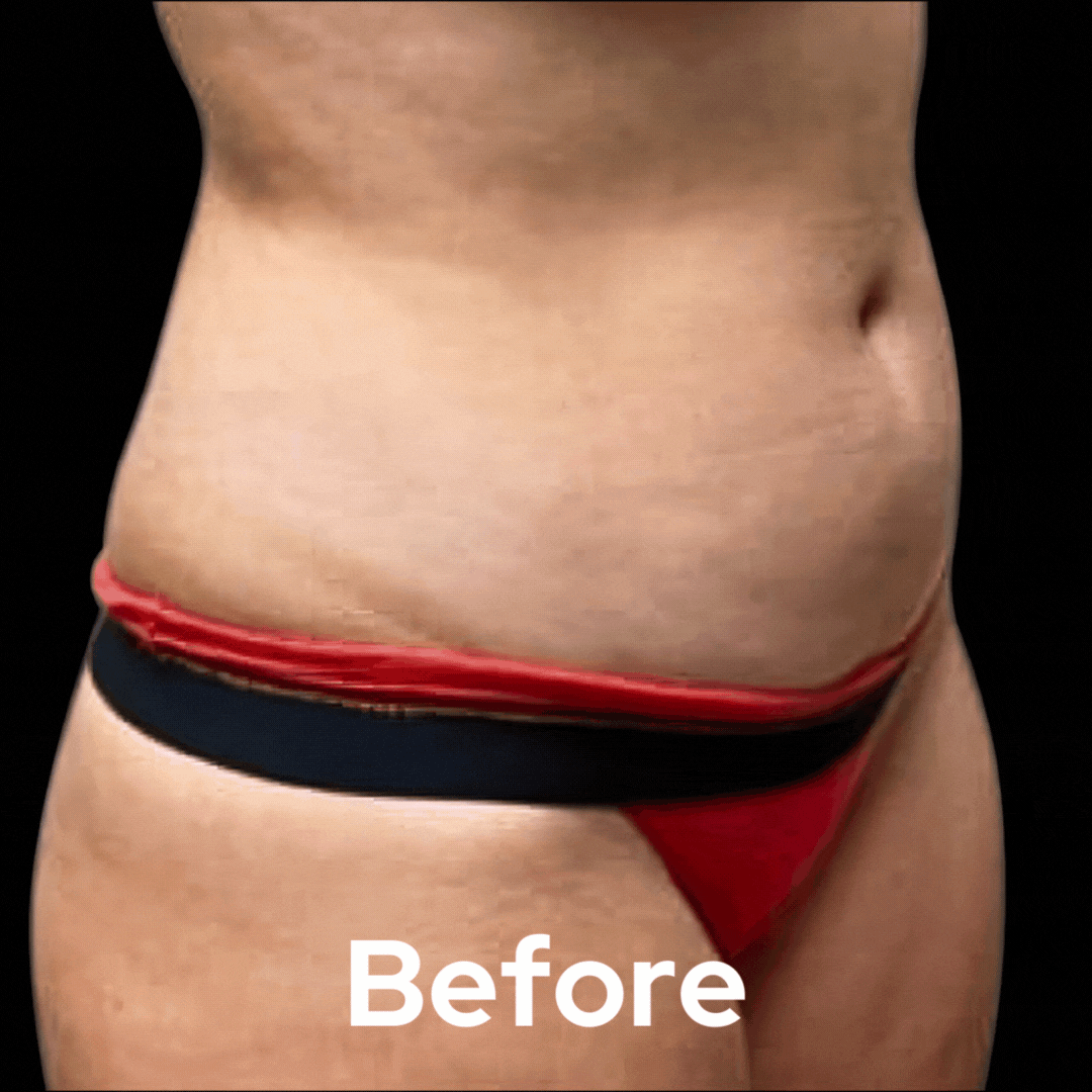 Lipo 360 - Before and After 01