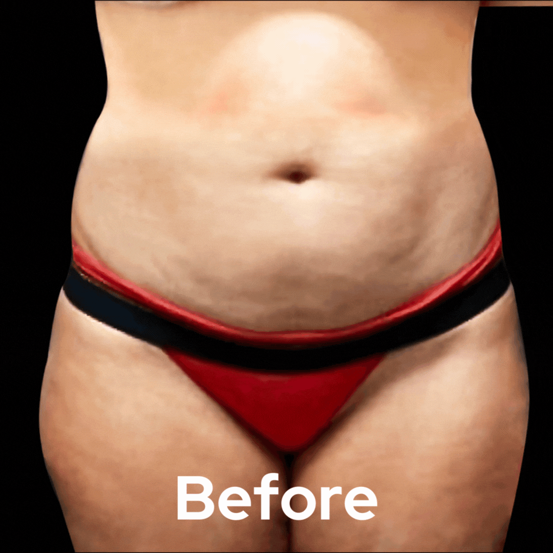 Lipo 360 - Before and After 02
