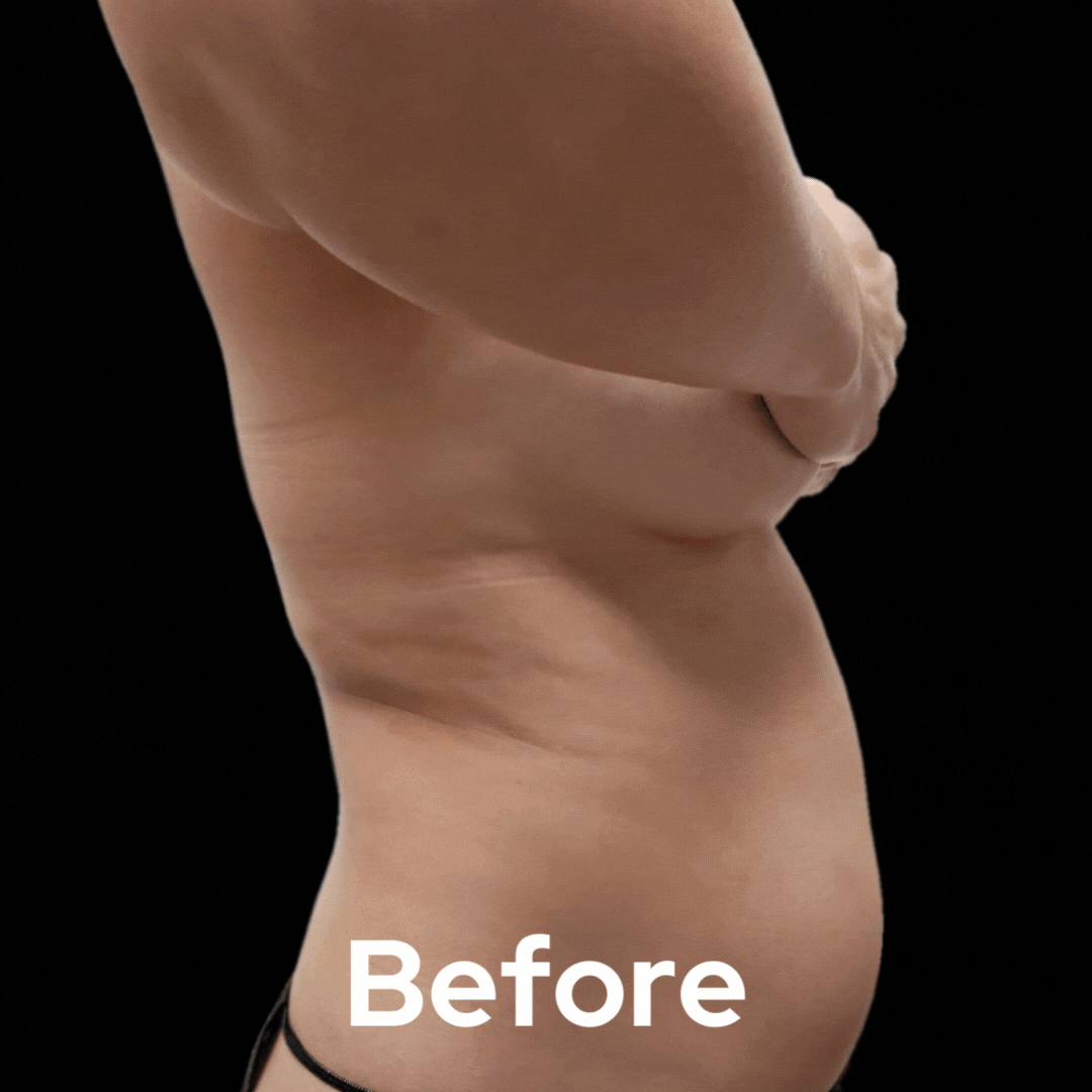 Lipo 360 - Before and After 04