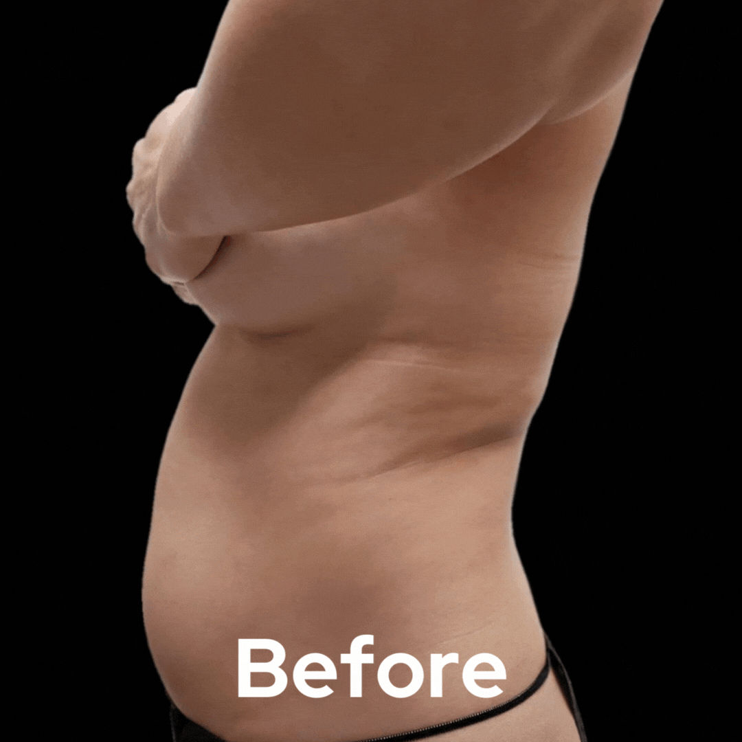 Lipo 360 - Before and After 06