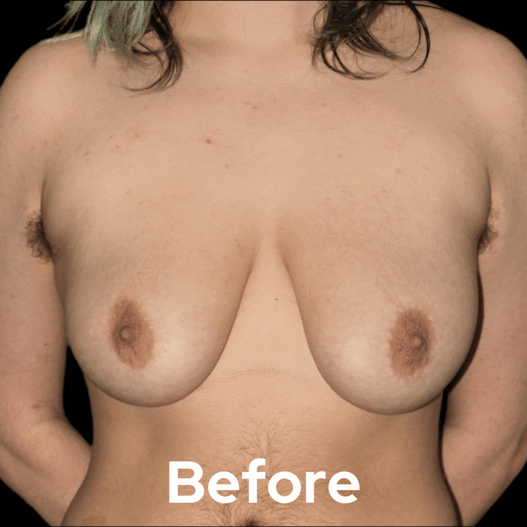 Transgender - Before and After 01