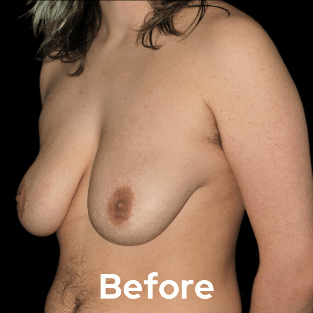 Transgender - Before and After 02