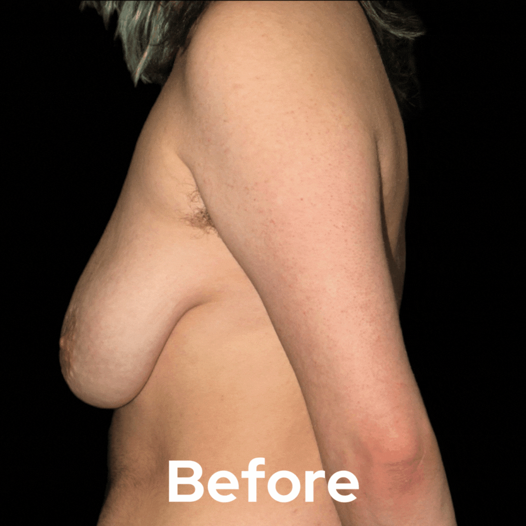 Transgender - Before and After 03