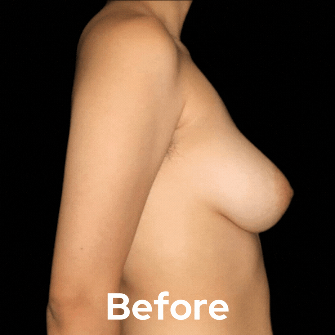 Transgender - Before and After 06