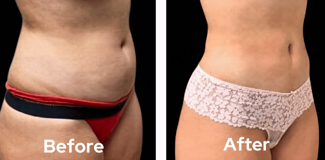 lipo-360-before-after-01-dr-garg