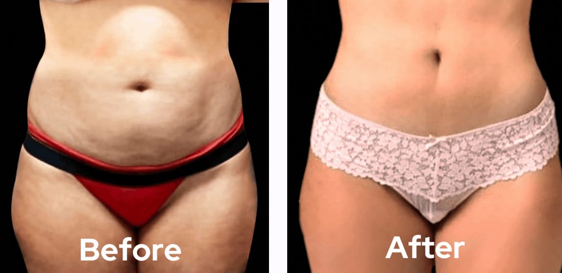 lipo-360-before-after-02-dr-garg