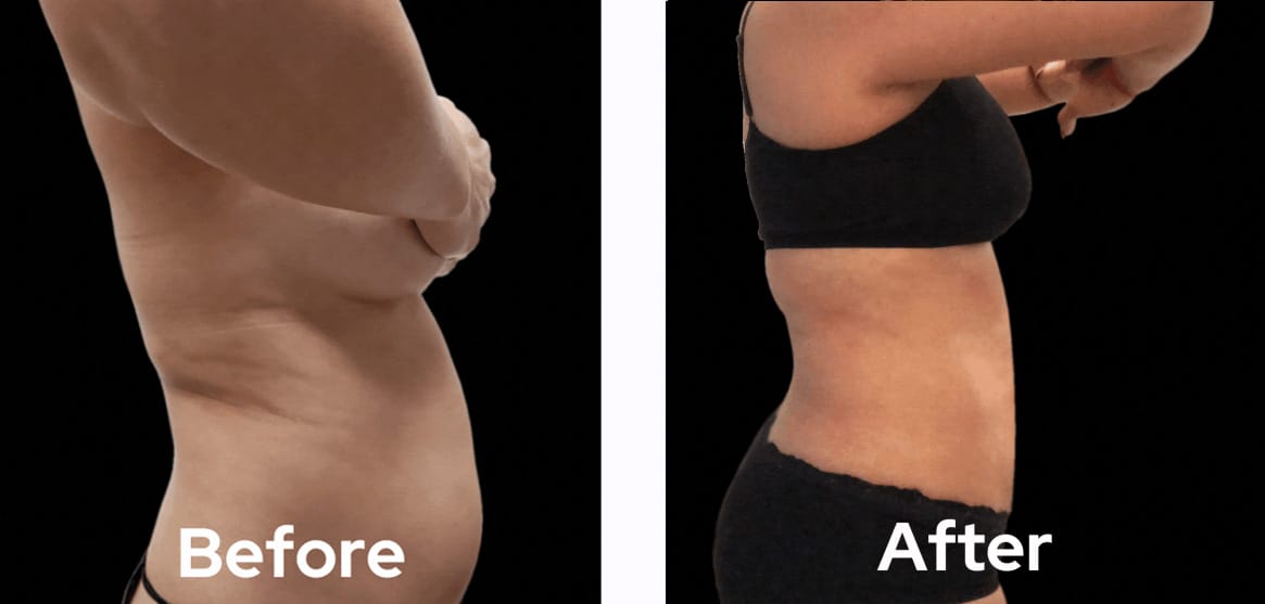 lipo-360-before-after-03-dr-garg