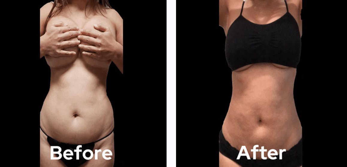 lipo-360-before-after-04-dr-garg